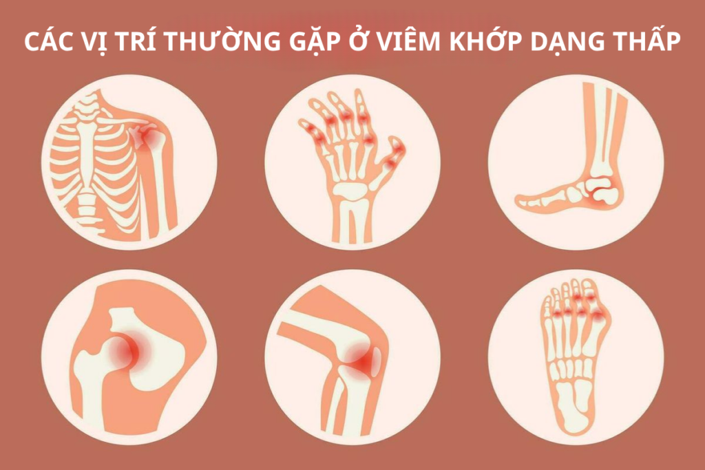 cac-vi-tri-thuong-gap-o-viem-khop-dang-thap