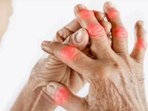 Viêm khớp gặp trở ngại mỗi khi thay đổi thời tiết