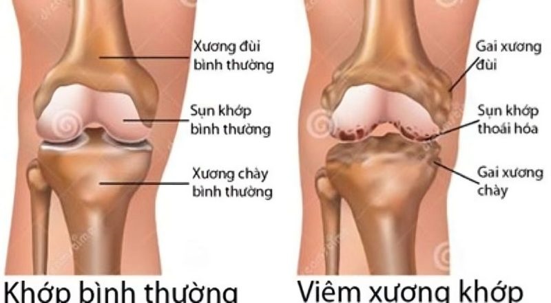 Hình ảnh mô phỏng Viêm khớp dấu hiệu thoái hóa thấp