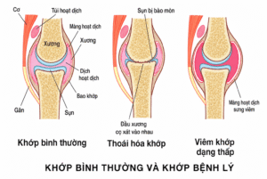 Tổng quan về viêm khớp