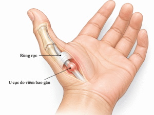 7 nguyên nhân gây cứng khớp ngón tay